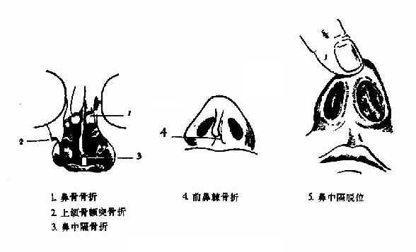 第一节鼻骨骨折fractureofnasalbone