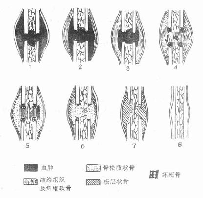 骨痂生长过程图图解图片