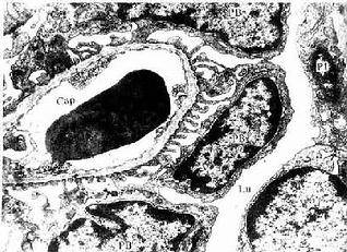 急进性肾小球肾炎电镜图片